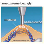 Wazektomia znieczulenie bez igly2