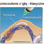 Wazektomia znieczulenie bez igly2